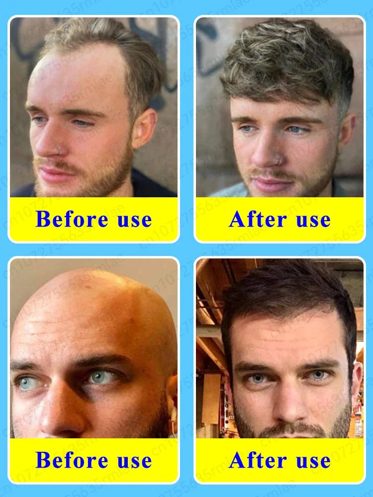 O rei do crescimento do cabelo, até mesmo pessoas calvas podem ter cabelos cheios