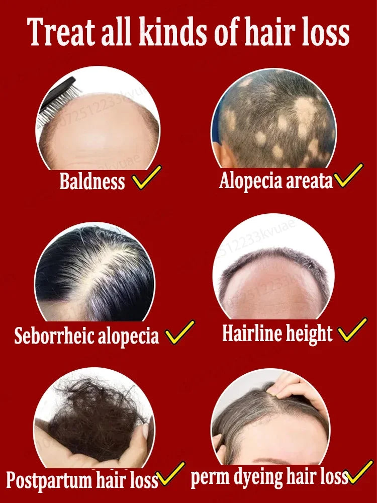 O rei do crescimento do cabelo, até mesmo pessoas calvas podem ter cabelos cheios