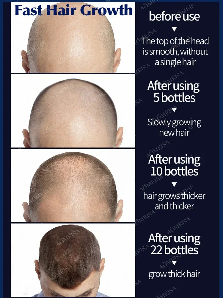 O rei do crescimento do cabelo, até mesmo pessoas calvas podem ter cabelos cheios