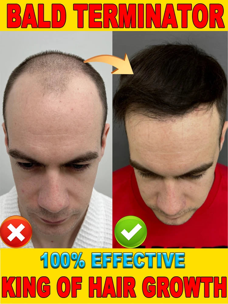 O rei do crescimento do cabelo, até mesmo pessoas calvas podem ter cabelos cheios